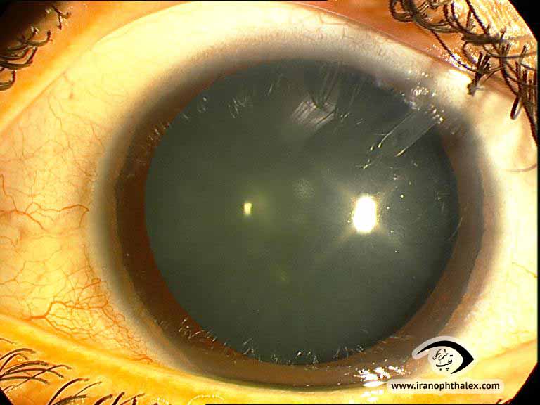 Neovascularization of iris